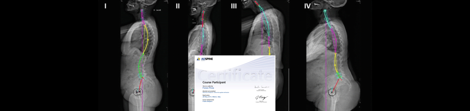 Seminario AO-Spine: Deformità Sagittale Nell’Adulto